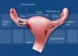 Endometriosis