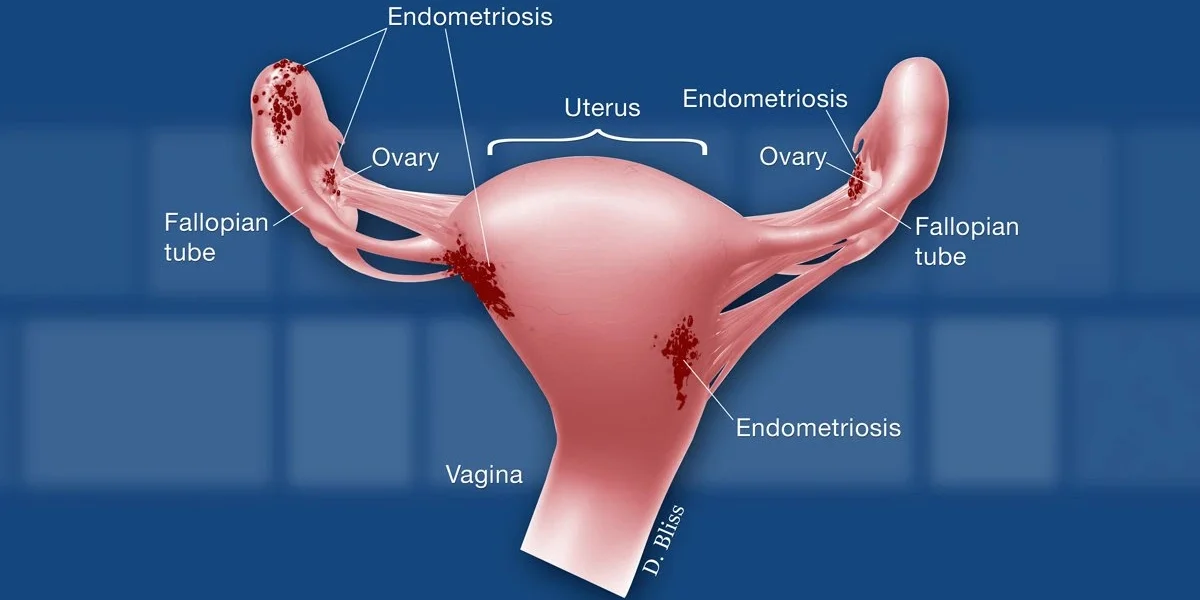 Endometriosis Endometriosis