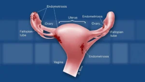 Endometriosis