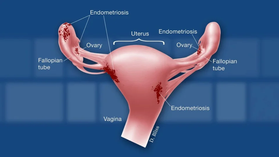Endometriosis Endometriosis